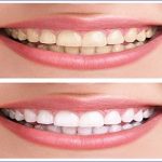 best charcoal teeth whitening