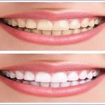 best charcoal teeth whitening